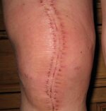 Knee uni op_stitches out  two days.jpg