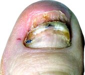toe.jpg