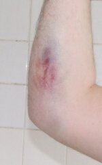 bruise.jpg